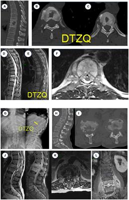 Real-time polymerase chain reaction detection and surgical treatment of thoracic and lumbar spondylitis due to Brucella infection: two typical case reports